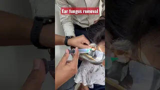 Ear fungus removal