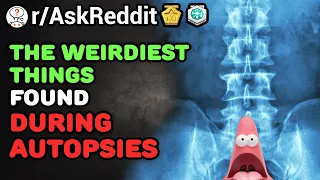 The WORST Things Found During Autopsies (/r/AskReddit) Reddit Stories