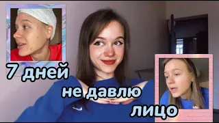 КАК Я ЛЕЧУ ПРЫЩИ? 💕 7 дней не давлю лицо!!!