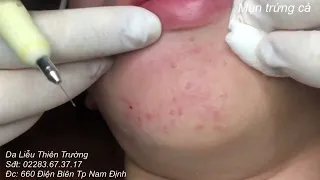 Bị mụn ẩn vùng mặt siêu nhiều, siêu to|Squezze big pimples,hidden acne full Dalieu ThienTruong