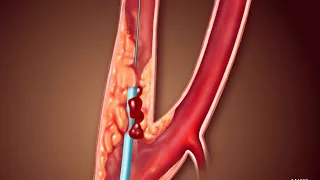 Voyage Through the Veins: An Animated Exploration of Carotid Angioplasty and Stenting