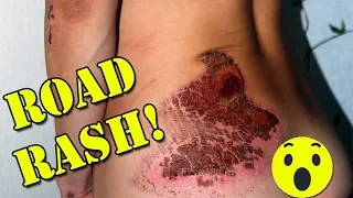 Healing Bad Road Rash Skateboard Crash - Skater Girl