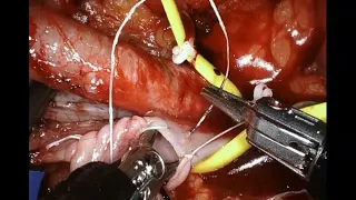 Single-Port Robotic-Assisted Extraperitoneal Kidney Transplantation (Graphic)