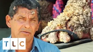 Luis Has Spent 40 Years Living With Extreme Viral Warts | Body Bizarre