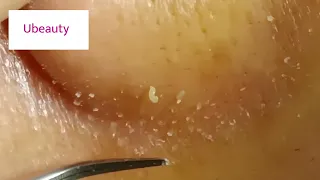 No squeezing whiteheads removal (Facial 37)