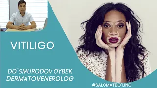 ВИТИЛИГО КАНДАЙ КАСАЛЛИК/  VITILIGO. ДЕРМАТОВЕНЕРОЛОГ ШИФОКОР ДУСМУРАДОВ ОЙБЕК. Ўзбекчада