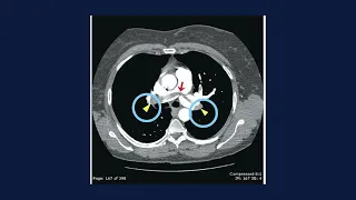 Strategies for the Team for Secondary Prevention, Treatment, and the Assessment of Bleeding Risk