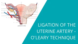 Ligation of the Uterine Artery - O'Leary Technique