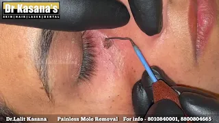 PAINLESS MOLE REMOVAL WITH RF CAUTERY BY DR.LALIT KASANA (+91-8010840001)