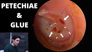 Petechiae And Glue Ear (Urgent ENT Referral)