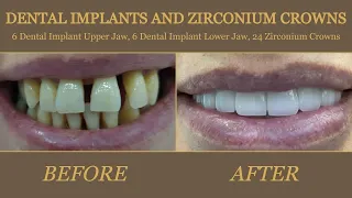 6 implant üst çene ve 6 implant alt çene ve 24 zirkonyum kaplama - (12 dental implants+full crowns)