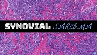 Synovial Sarcoma | Spindle Cell Unknowns (Case #3) | #BSTPATH Cases for Residents