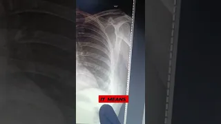 Chest x ray in one minute | NEET PG |