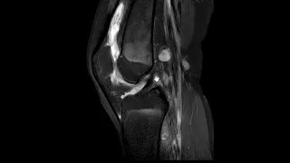Septic arthritis of knee (joint infection).