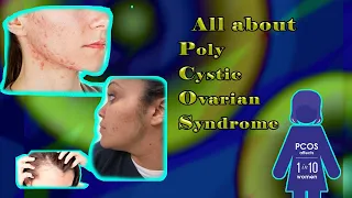 All about Polycystic Ovarian Syndrome (Urdu/Hindi)