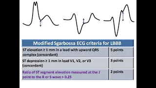 ECG course: Acute or Chronic LBBB? Dr. Sherif Altoukhy
