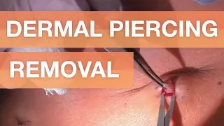 Dermal Piercing Removals (and stitching)!