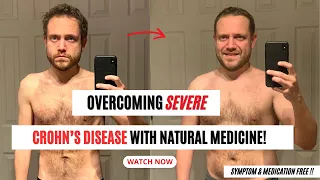 Reversing Severe Crohn's Disease with Natural Medicine! Watch How!