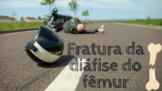 Fratura de fêmur -  Reabilitação