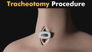 How Tracheotomy is performed? | Tracheotomy 3D Animation (Urdu/Hindi)