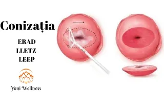 S2. Ep 30 - CONIZAȚIA | ERAD | LLETZ | LEEP | Biopsia de col | HPV | HGSIL | LGSIL | ASC-US