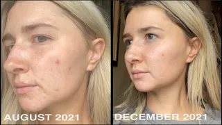 MICRONEEDLING UPDATE - GETTING RID OF ACNE SCARRING