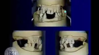 DENT 718: Tooth supported overdentures