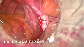 medial approach for uteteric dissection