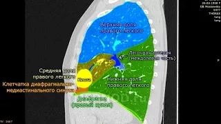 Удаление нагноившейся эхинококковой кисты легкого (резекция средней доли легкого)