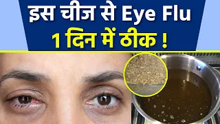 आई फ्लू से 1 दिन इस घरेलू उपाय से छुटकारा | Eye Flu Hone Par Kya Kare | Eye Flu Home Treatment