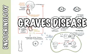 Graves Disease - Overview (causes, pathophysiology, investigations and treatment)