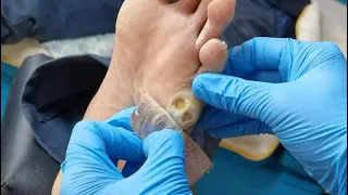 Pedicure Tutorial: How to treat plantar wart. Plantar wart removal. Two warts on the sole.