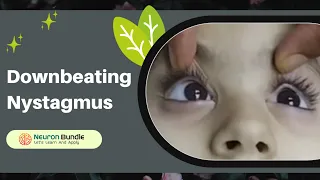 vertical eye movements | nystagmus | downbeat nystagmus  #nystagmus #verticalnystagmus