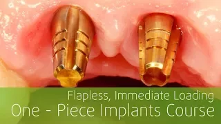 Flapless Immediate Loading One-Piece Implants