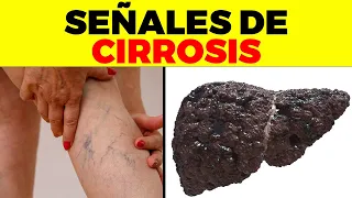 ASI EMPIEZA la CIRROSIS y nadie te lo dice, signos y síntomas de cirrosis