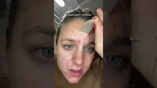 Satisfying Pimple Patch Peels