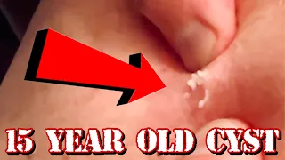 Draining a 15 YEAR OLD Cyst | HARD POP | Very Satisfying Release - #TheBubbaArmy