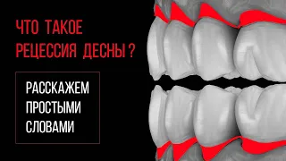 Что такое рецессия десны [простыми словами]❓