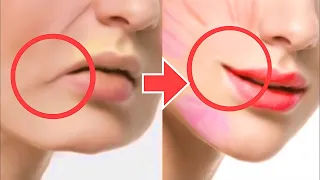 Lift Lip Corners, Fix Droopy Mouth Corners, Fat Around The Mouth, Sagging Cheeks. Asymmetrical Lips