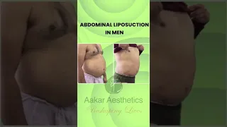 Abdomen liposuction in Men