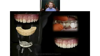 BASICS OF INJECTABLE TECHNIQUE in anterior and posterior dentition - Free Webinar