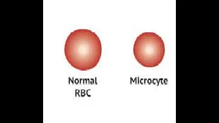 Anemia microcítica