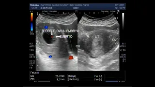 A Pregnancy of 7 weeks, Ultrasound Findings.