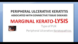 Ophthalmology 125 a PERIPHERAL ULCERATIVE KERATITIS PUK    MARGINAL KERATOLYSIS Melting