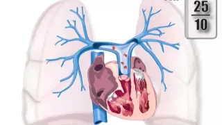 caillots sanguins dans les artères pulmonaires