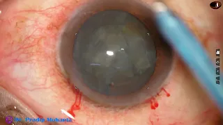 Management of a posterior subcapsular cataract - by prechopping- Pradip Mohanta, 29th January,  2022