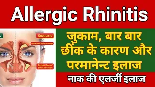 जुकाम, एलर्जी, छींक का पर्मनेन्ट इलाज | Allergic Rhinitis Treatment - Permanent solution Allergy