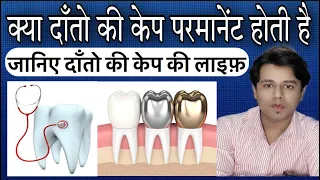 Danto ke cap ki kya life hoti hai | कितना चलता है दांत का कैप I dental cap life