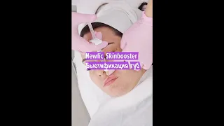 Бьютификация губ с помощью препарата Newlic Skinbooster