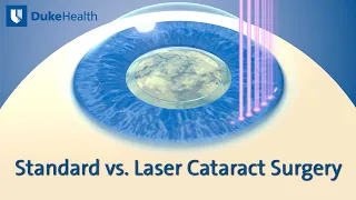 Standard vs. Laser Cataract Surgery | Duke Health